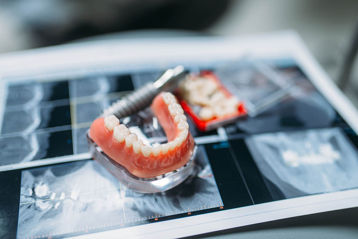 Myths About Dentures Exposed