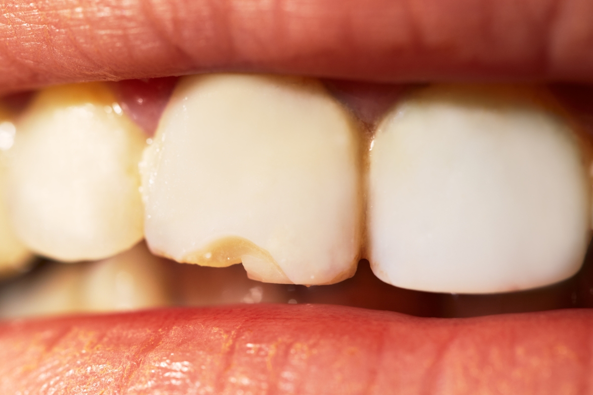 What do I do when a tooth breaks