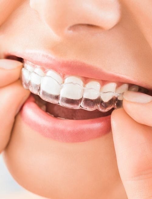 Straighten Teeth discreetly with Invisalign Treatment