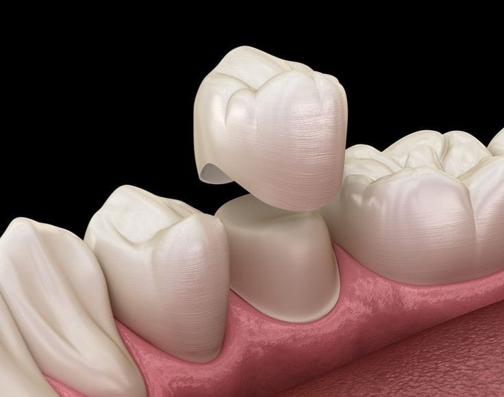 Looking for a crown dental at Dental Care Centre!