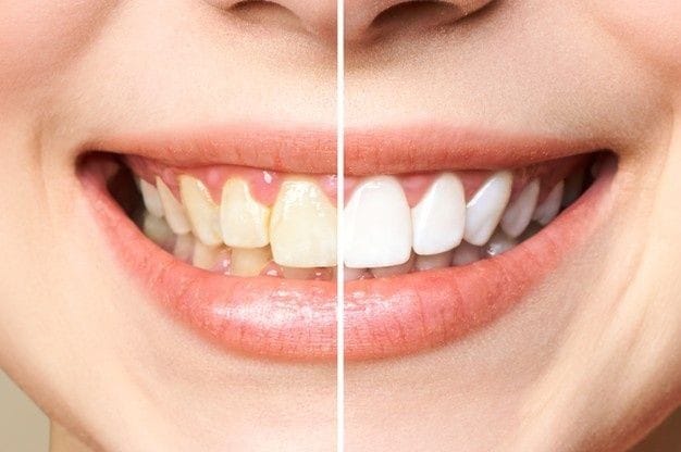 Best teeth whitening technique