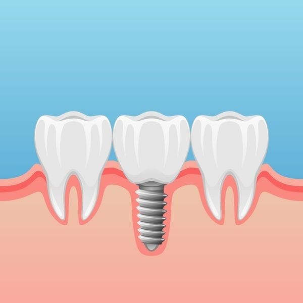 Tooth Transplant Cost