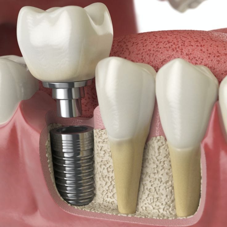 Flawless smile with affordable and Cheap dental implant