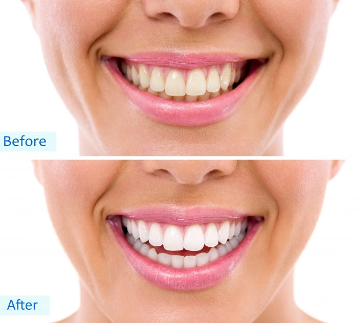 Sensitive teeth whitening treatment – Get a radiant smile