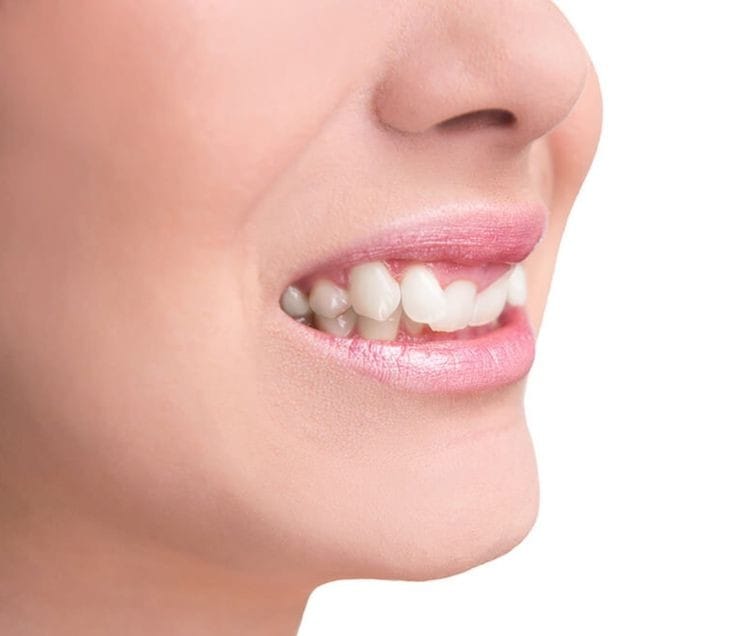 Smile Direct Club – What are the dangers?