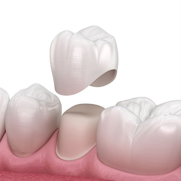 Regain a Durable Radiant Smile with Zirconia Dental Crown