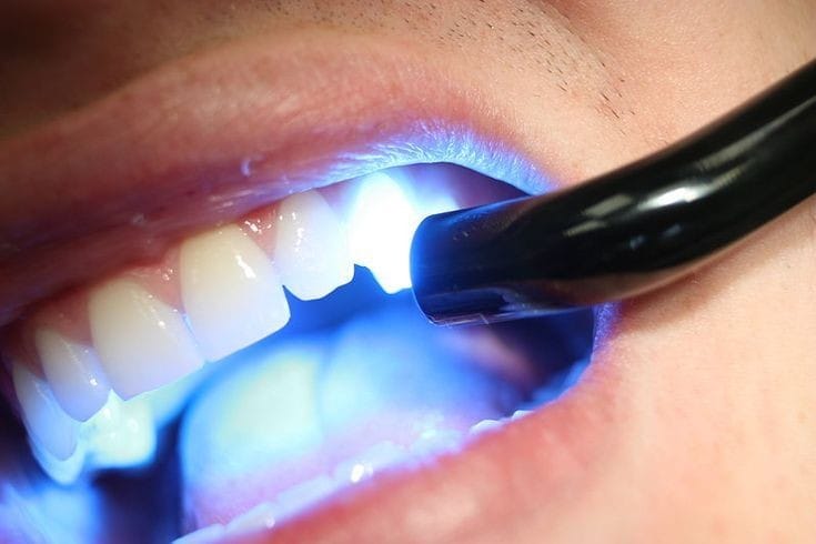 Composite dental filling