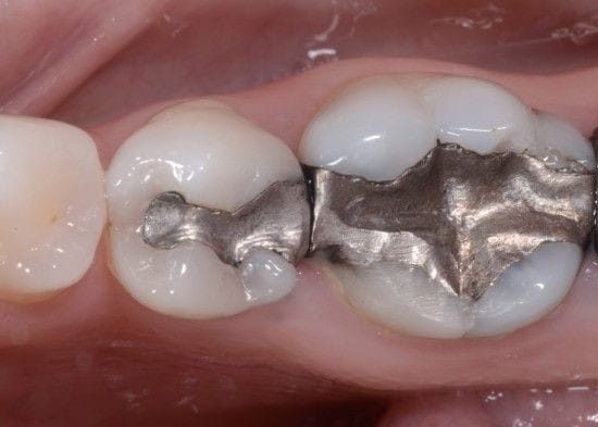 Filling amalgam