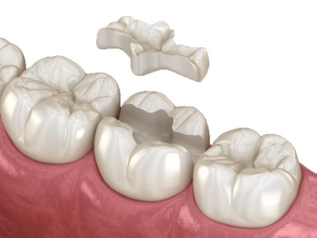 Inlay dental
