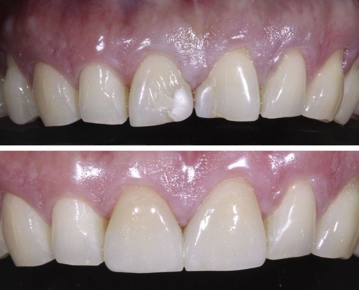 Filling for front teeth