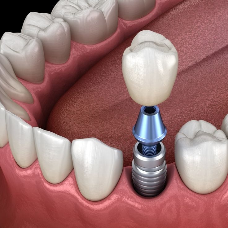 One-tooth implant