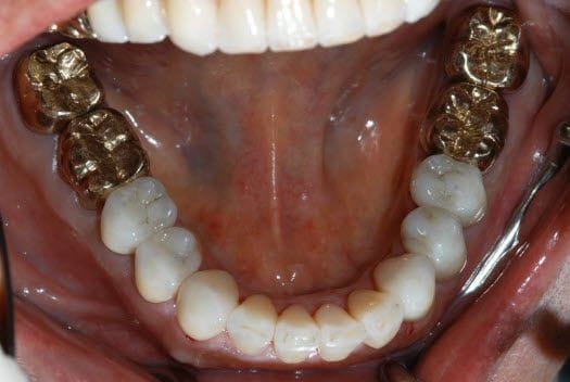 Gold Tooth Gap