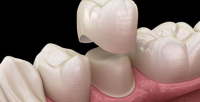 Porcelain Tooth Crown