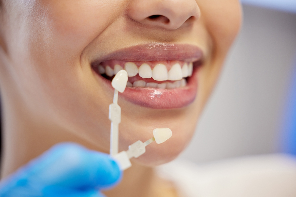 right-dental-veneers