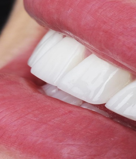 dental-veneer