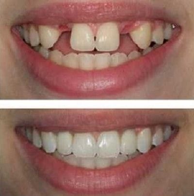 embarrassed-teeth