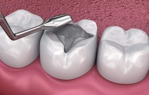 amalgam-ban
