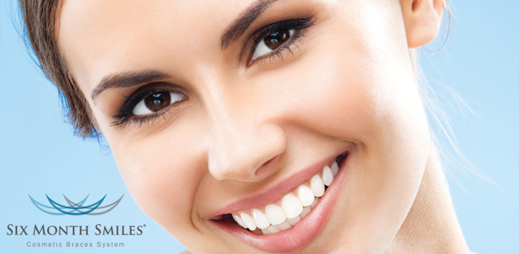 14938977724-things-you-should-know-about-6-month-smiles-treatment 6-Month-Smiles