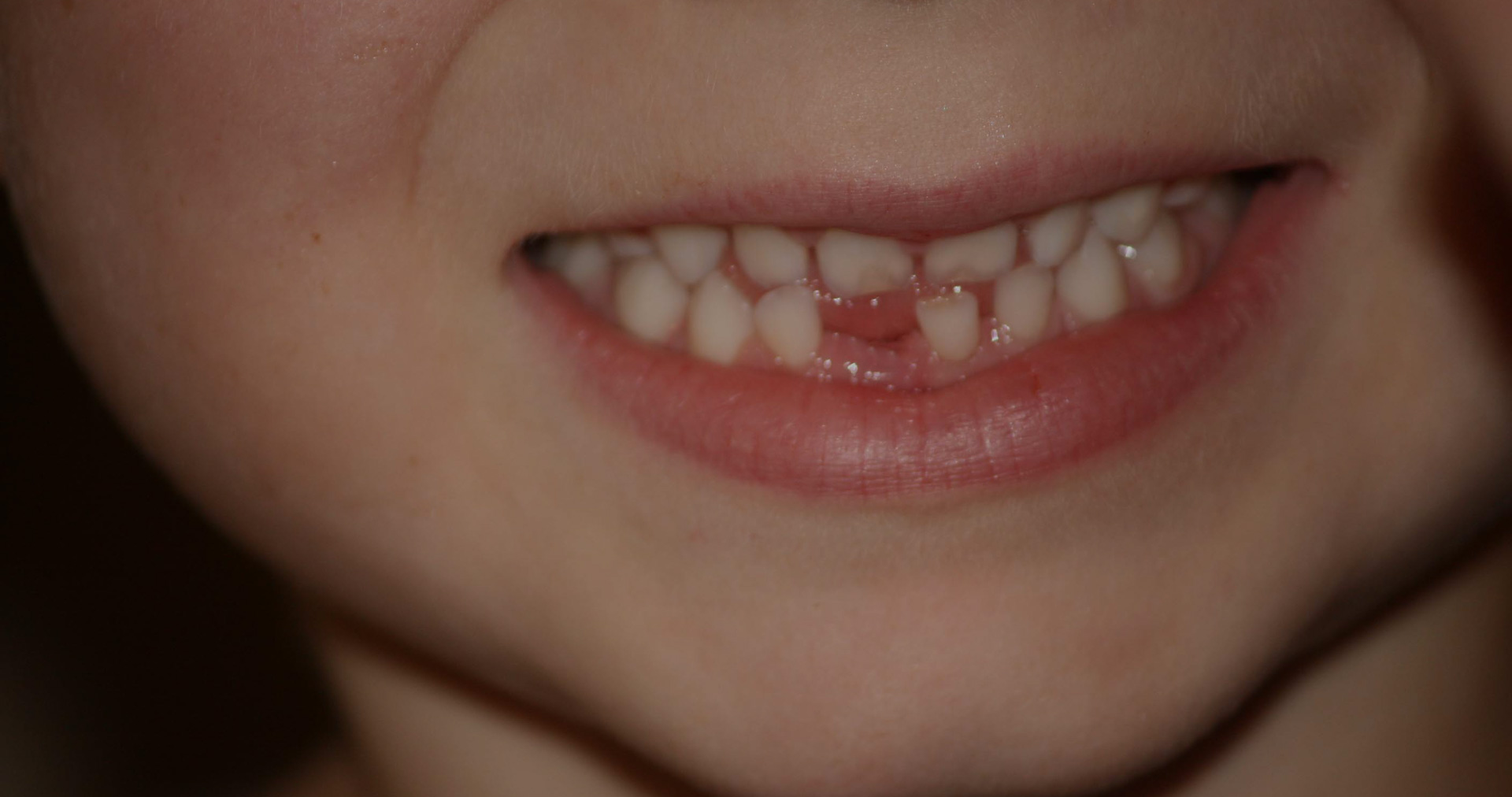 Lost-Tooth-2 Lost-Tooth-2