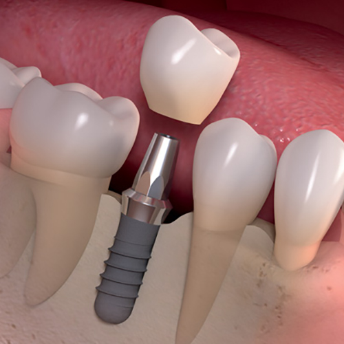 Single-Dental-Implant Single-Dental-Implant