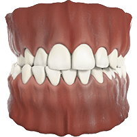 iCross Invisalign