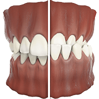 iUnderOver Invisalign