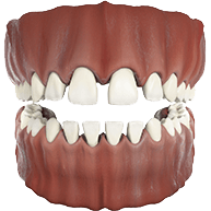 iWidelySpaced Invisalign
