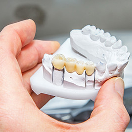 dental-care-center-bridges