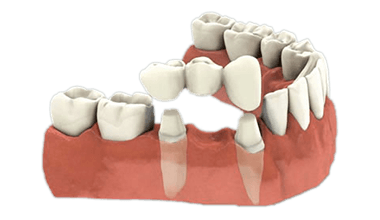 dental-care-center-crown_product