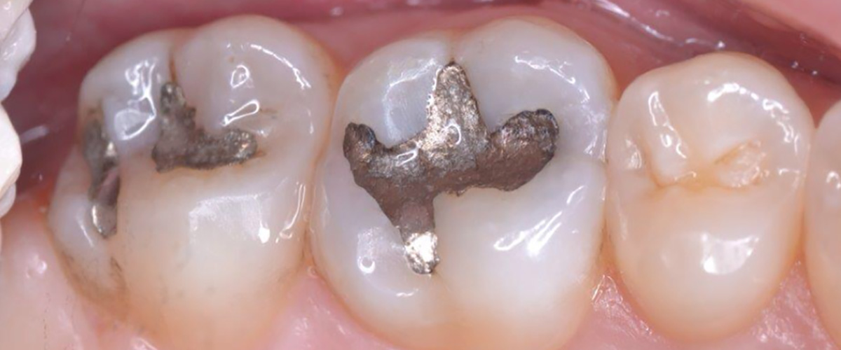 dental-care-center-dental-fillings-before