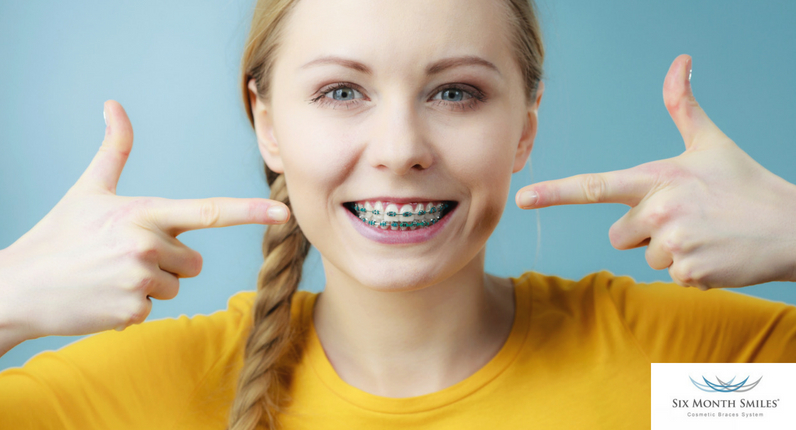 dental-care-center-teeth-straightening-six-month-smile