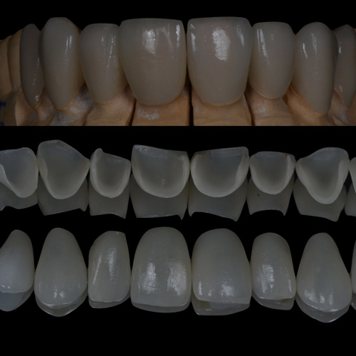 dental-care-center-veneers