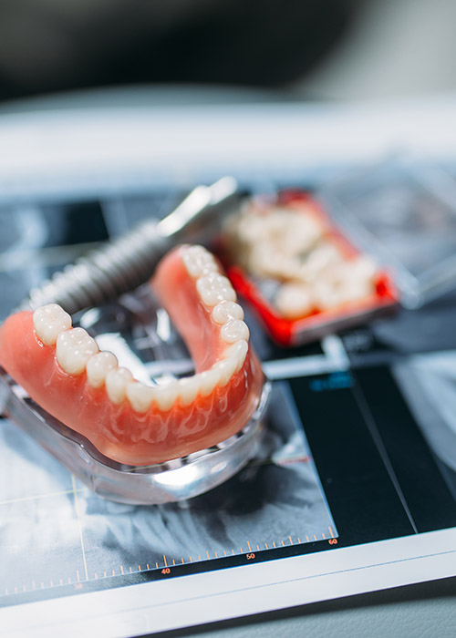 flexible-dentures-london