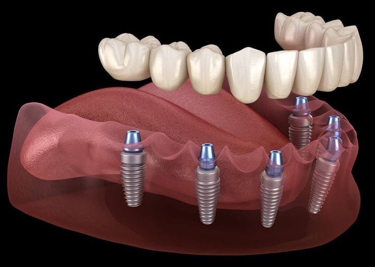 all-on-six-dental-implants
