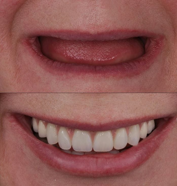 full-mouth-dental-implants Full Mouth Dental Implants