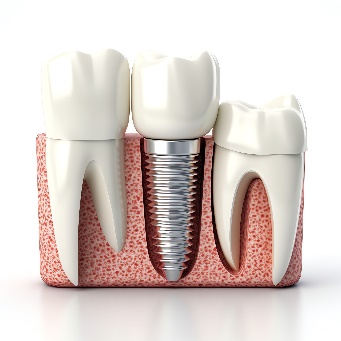 implant