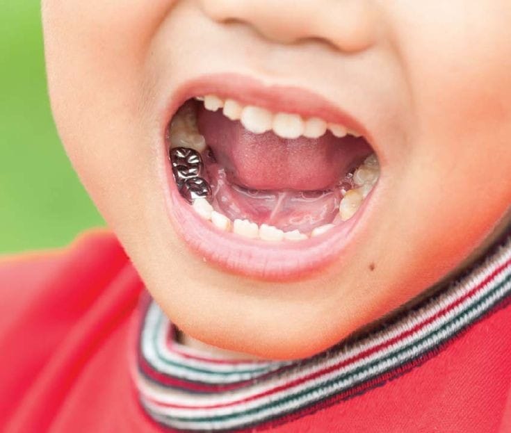 Silver crown tooth Strengthen your tooth integrity Dental Care Centre
