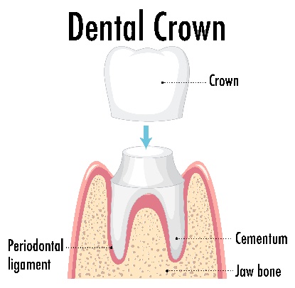 dental-crowns-02