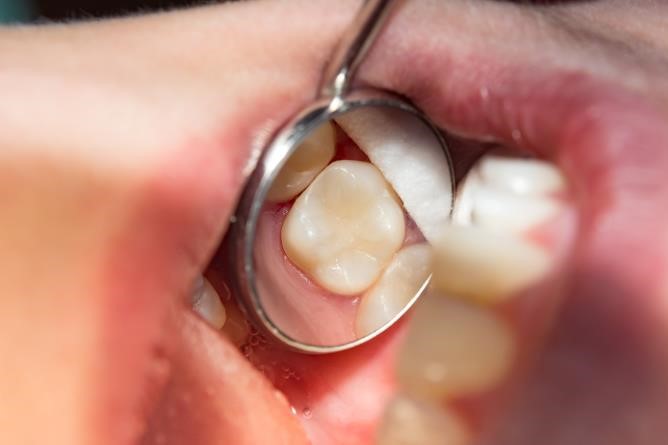 dental-fillings-02