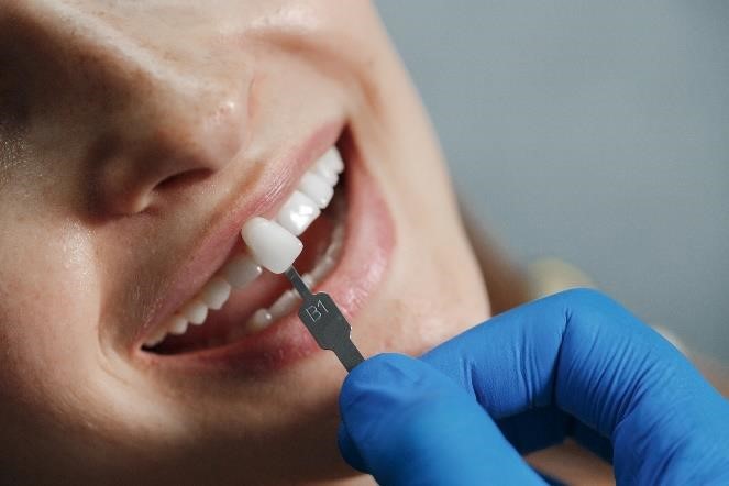 dental-fillings-03