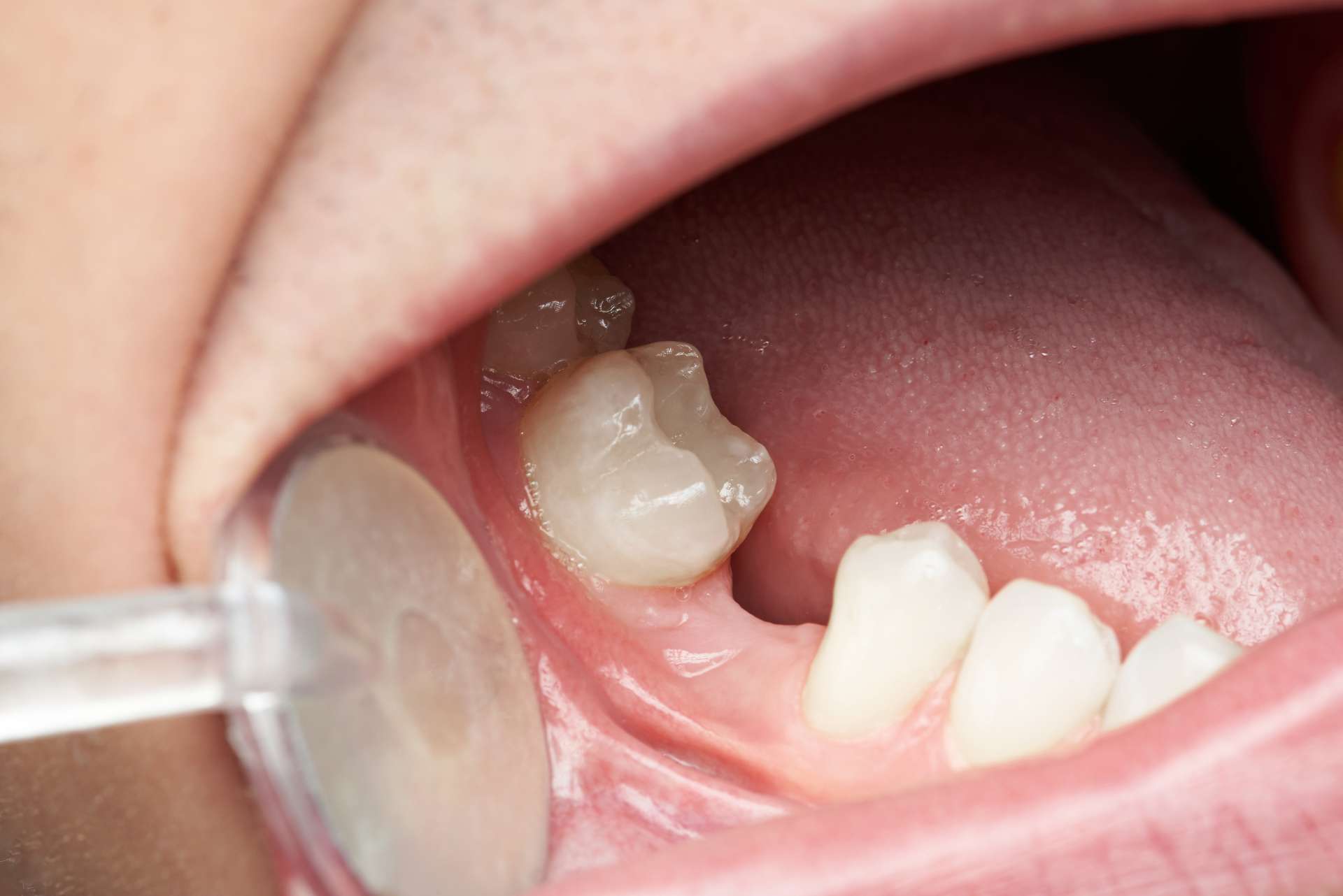lost-tooth-02