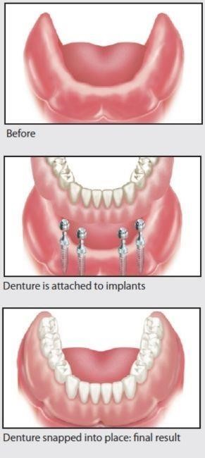 edentulous-lower-jaw-2