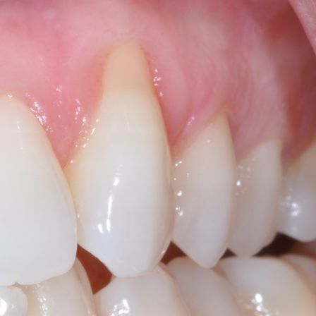 gum-graft