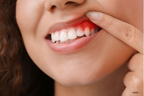 periodontal-therapy-02