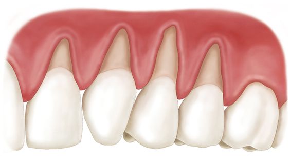 periodontal-therapy-03
