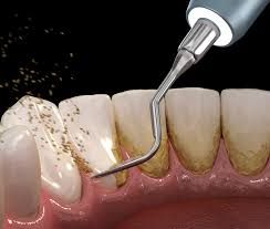 periodontal-therapy03