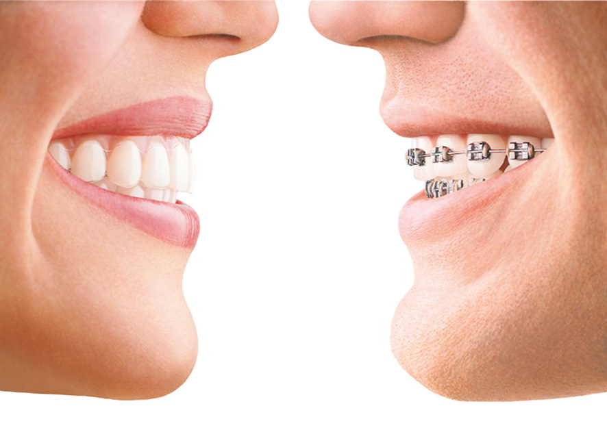 invisalign-bg Invisalign